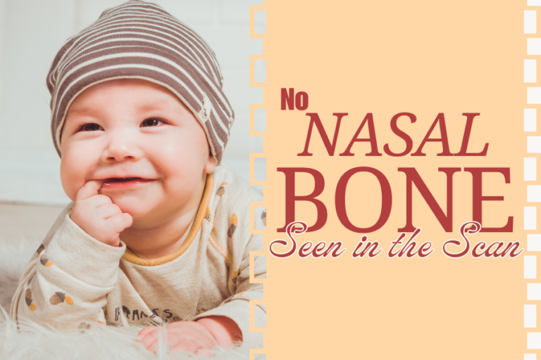No Nasal Bone Seen in the Scan