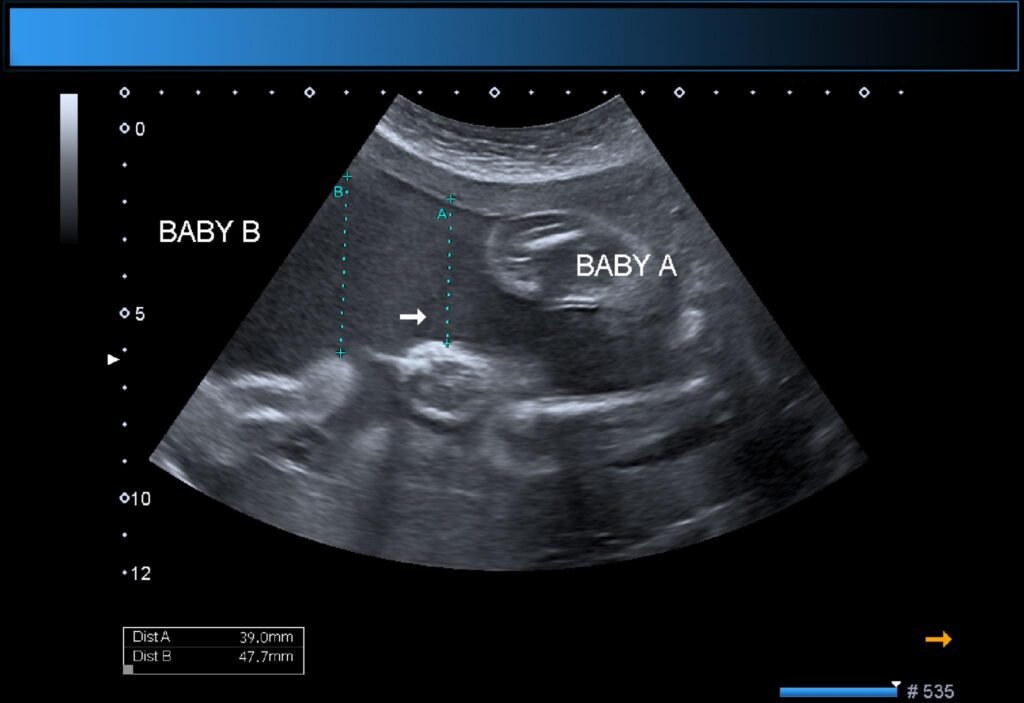 Twin Pregnancy Scan