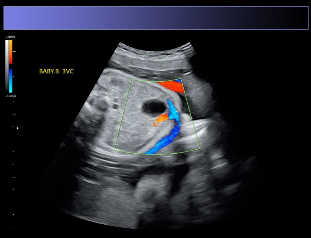 Twin Pregnancy Scan