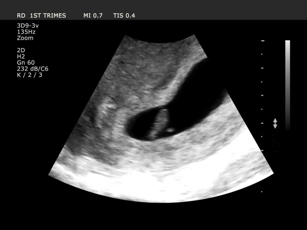 Dating Scan in Pregnancy