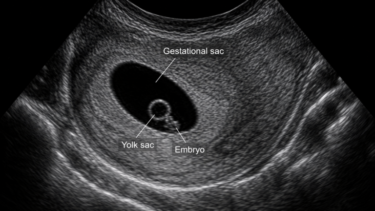 Gestational Sac in Pregnancy: What It Really Means