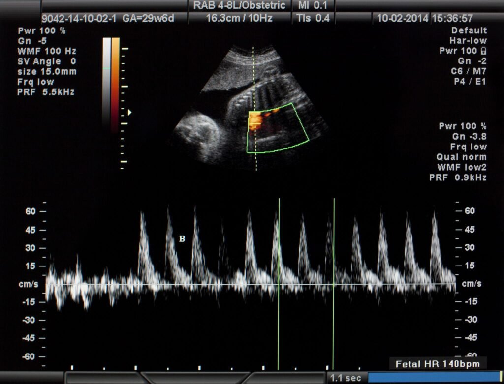 Fetal Heart Block in Pregnancy