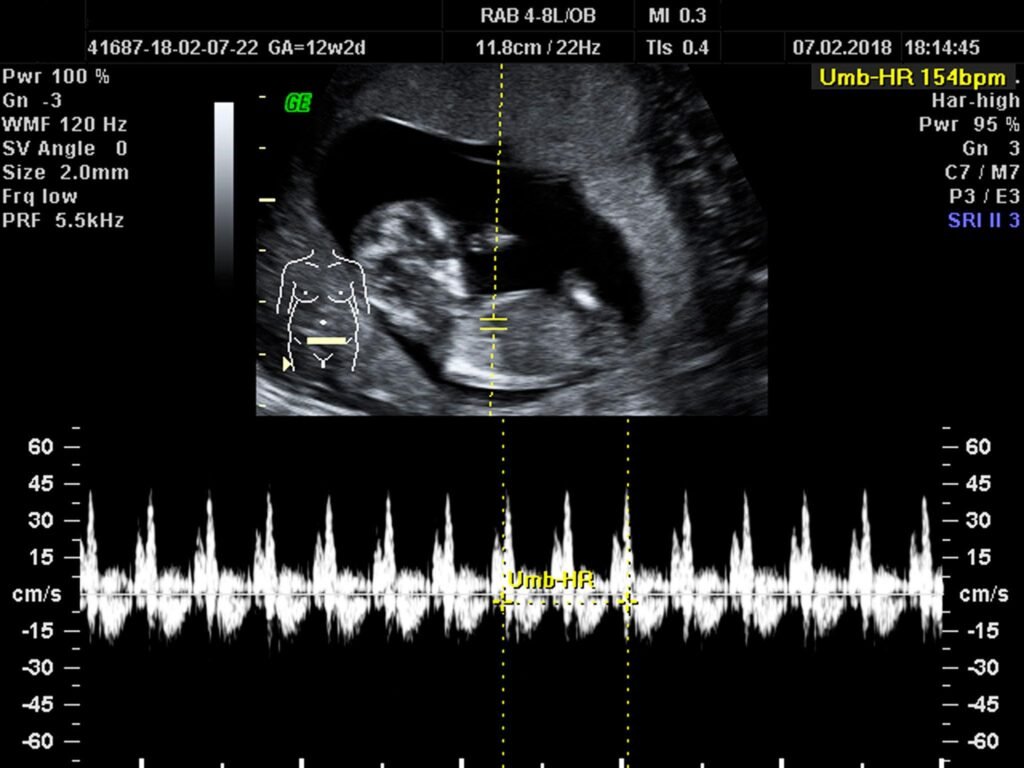 Baby Heartbeat During Pregnancy