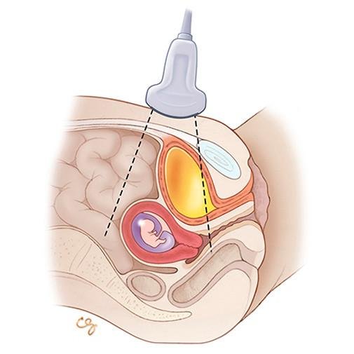 Empty Sac on Pregnancy Scan