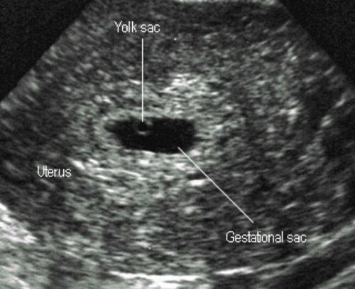 Empty Sac on Pregnancy Scan