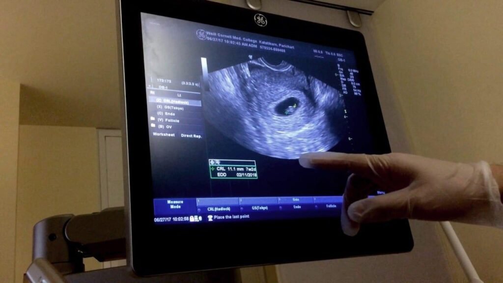 Empty Sac on Pregnancy Scan