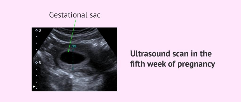5-week pregnancy scan